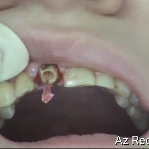 Клинический случай — установка штифта в канал, видео